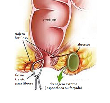 Ilustração representando absesso anal
