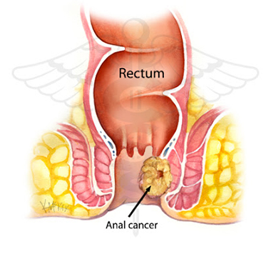 Ilustração representando câncer anal
