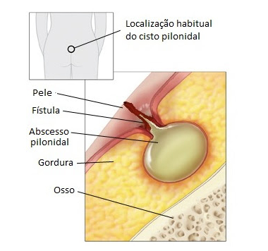 Ilustração representando cisto pilonidal