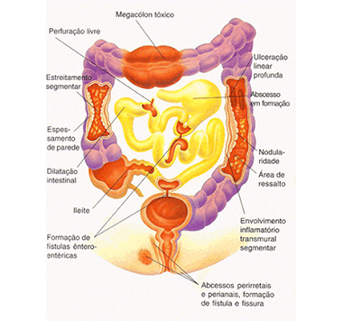 Ilustração representando doença de Crohn