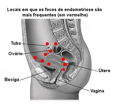 Ilustração representativa de Endometriose Pélvica