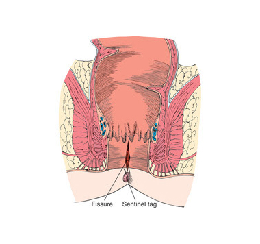 Ilustração representativa de Fissura Anal