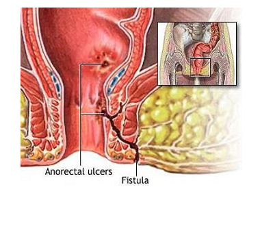 Ilustração representativa de Fístula Perianal