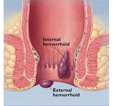 Ilustração representativa de Hemorróidas